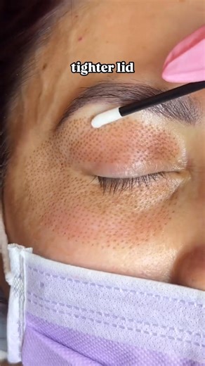 63K views · 199 reactions | The Plasma Lift Skin tightening procedure...