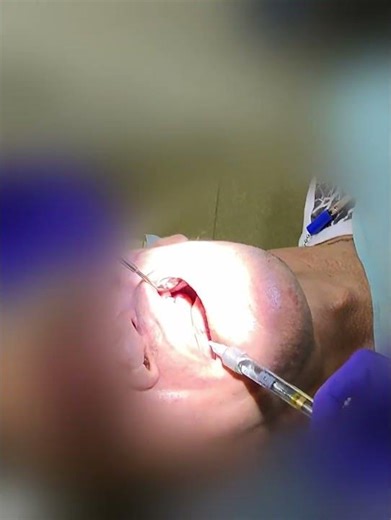 Maxillary Canine Tooth Extraction @DentistPOV