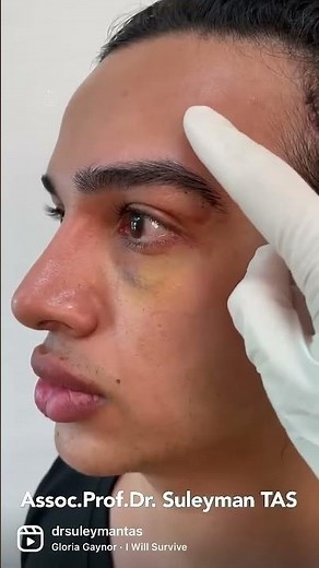 Fox Eyes Surgery | Before And 5 Days After