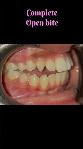 Complete bite correction with metal braces #open bite#champawat #smile #Dr Babita Verma MDS