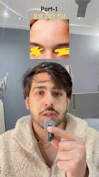 Part-1 Know about acne face mapping 🙌🏻