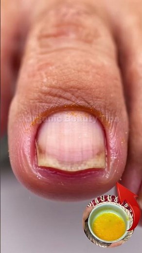 Stubborn toenail fungus!Simple home care + consistency = healthy nails again 💚🦶