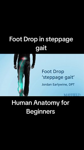 Foot Drop: Understanding Steppage Gait and Its Effects
