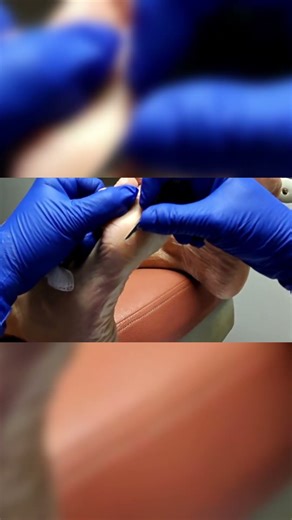 Dealing with Persistent Skin Bumps 🦶😬🔍 Here’s why trimming alone isn’t enough