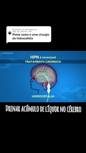 Válvula en la cabeza: cirugía y cuidados a considerar