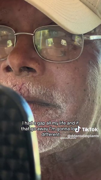 Permanent teeth in 24 Hours 💫 The difference with our process, All-On-Bar, is that the titanium bar helps to connect those implants with each other, so they do not move while they are healing. That is what we call teamwork.