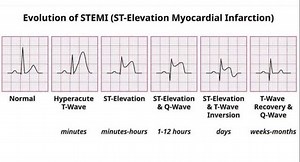75K views · 1.1K reactions | Evolution of STEMI ( ST Elevation Myocardial Infraction) . . #ecginterpretation #ecg #ecglovers #mi #heartattack #myocardialinfarction #mbbs #mbbsstudent #viral #medical #tranding #doctor #nursing #nursingstudent #doctors #cardiology #neetpg #fmge | medicalmania007 | Facebook