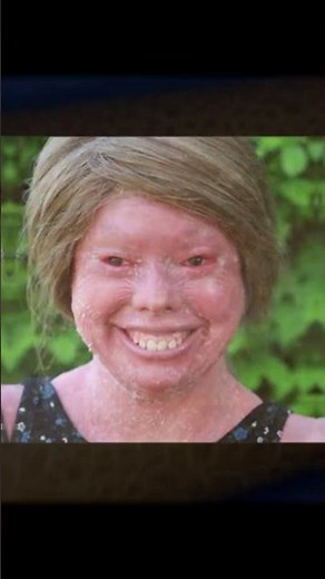 Harlequin Baby | Severe Rare Skin Condition Awareness