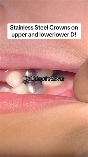 Stainless Steel Crowns and Pulpotomy Treatment Explained
