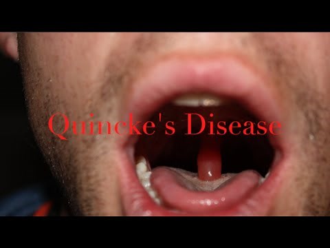 quinckes disease - medical minute