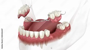 Removable partial denture, mandibular prosthesis. Medically accurate 3D animation of prosthodontics concept Stock Video