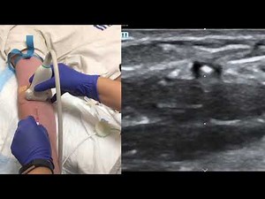Ultrasound Guided Peripheral IV - Short Axis Approach