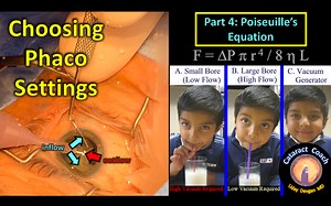 Phaco Fundamentals Part 4: Poiseuille’s Equation