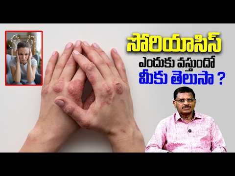 సోరియాసిస్ ఎందుకు వస్తుందో మీకు తెలుసా ?| Main Causes Of Psoriasis | Prayaga Rama Krishna | CVR