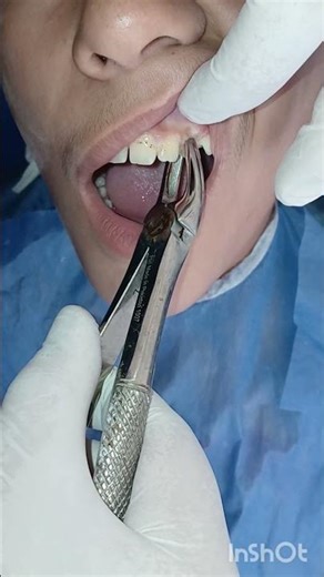 Infected tooth extraction 😬 #dentist #satisfying