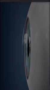 7K views · 30 reactions | What is Keratoconus #keratoconus #eyesurgery #crosslinking #opthalmologist #beverlyhills. | Dr. Brian Boxer Wachler | Facebook