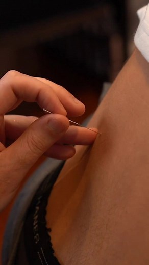 Watch instant results with Dry Needle Acupuncture using Trigger Point Therapy! #acupuncture #foryou #oddlysatisfying #doctorsoftiktok