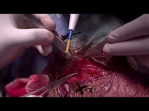 Modified Radical Neck Disection | Metastatic Papillary Thyroid Cancer | MRND | live Q's & A's |