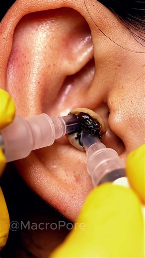 Vacuum Ear Blackhead Removal 👂 Ultra Clean ASMR 4