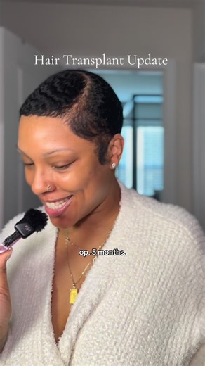 Growing My Edges ✨ on Instagram: "Hair Transplant Mini Update 💕 5 Months Post Op 🙌🏽 . . . . . . #tractionalopecia #haircarejourney #hairtransplant #hairtransplantturkey #hairtransplantistanbul #alopecia"