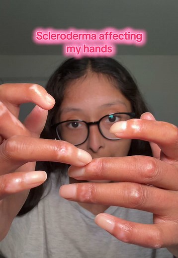Understanding Scleroderma Symptoms and Impact on Hands