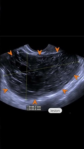 a complex ovarian mass lesion.👉 Possibilities include:Ovarian neoplasm (benign or malignant)