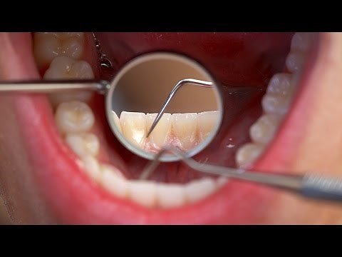 How Many Teeth Should Adults Have? | Tooth Care