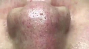 Pimple Popping 2021 | Rate this video 1-10? | Instagram