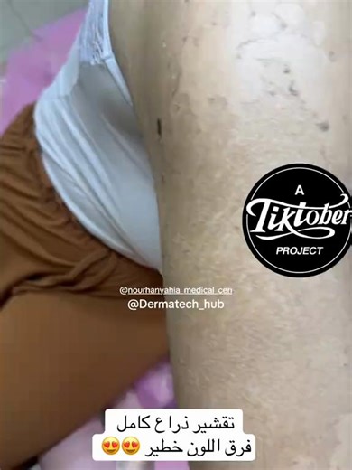 فيديوهات أنشأها derma tech hub (@derma.tech.hub) باستخدام الصوت الأصلي - derma tech hub
