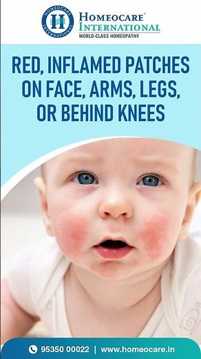 Symptoms of Eczema in Kids