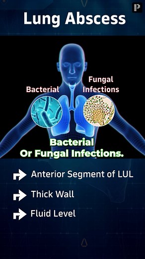8K views · 40 reactions | Watch the reel to understand the Important Pathologies of Chest X-Ray. #xray #chestxray #Pathology #lungs #abscess #LungAbscess #PrepLadder | PrepLadder Medical | Facebook