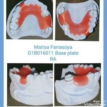Prosedur Pembuatan Gigi Tiruan Sebagian Lengkap(GTSL)/Partial Denture