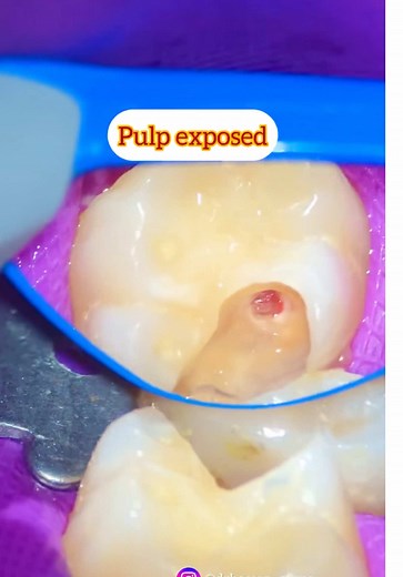 Successful Partial Pulpotomy Procedure Explained