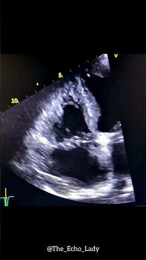 Fibroelastoma! 🩵 #echocardiogram #cardiology #echocardiography #cardiologia #ecocardiograma