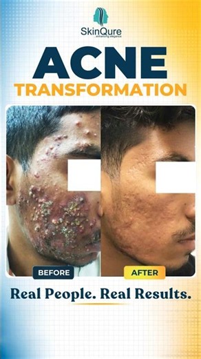 Acne Transformation You Need to See! 😲 | Before & After | ‪@skinqure‬