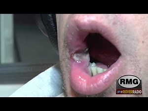 Jeffrey has massive infected crater he calls a "cold sore"