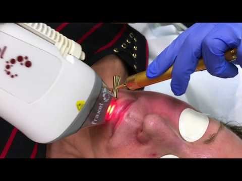 Fraxel Dual Laser