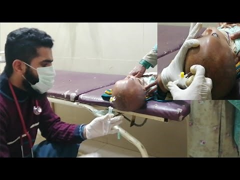 Ventricular Tapping in neonates || Easy way to do Ventricular Tap || Neurosurgery depart. BVH