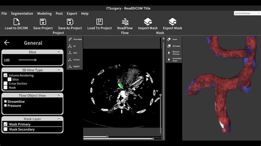 開発中のiTSurgeryです！心臓手術を仮想的に行うことで手術する前に術後の血行動態をシミュレート。仮想的に人工血管なども追加できます。来年リリース予定です。研究用