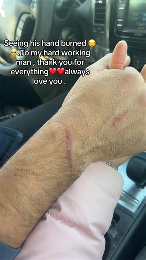 Best Medicine for Treating Burns on Hands