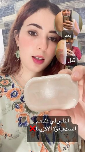 Amina terhlat on Instagram‎: "العلاج الأول في امريكا الصابون المرطب عميق المفعول لمعالجة #داء_الصدفية بأنواعها المختلفة ➰➰➰➰➰➰➰➰➰➰➰➰➰➰➰➰➰ 💢يعالج أعراض #الصدفية من بداية ظهورها. 💢يساعد على توقف الحكة والاحمرار والتقشر الي يتكون نتيجة مرض الصدفية. 💢بفضل مكوناته الي تحتوي على مواد ملطفة للبشرة الي تتغلل للجلد عميقا حتى تسمح للمكونات الفعالة الي هي coal tar للعمل لفترة أطول والبقاء بتماس مع الجلد المصاب لساعات لذا يفضل استخدامه أثناء الليل قبل النوم 🌙🌃 يحتوي على العناصر المرطبة الوفيرا والبيساب