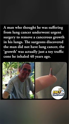 Man's "lung cancer" turned out to be a toy cone he inhaled 40 years ago. #MedicalMystery #Surgery