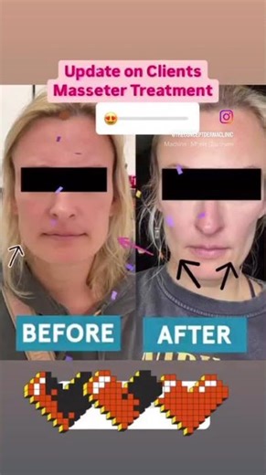 Face masseter Botox uses botulinum toxin injections to relax the jaw muscles and facial sliming