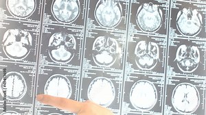 forefinger shows areas on CT scan