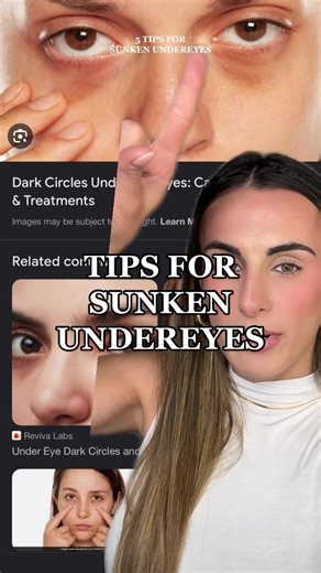 5 Tips for Sunken Undereyes