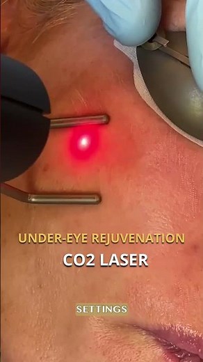 CO2 Laser: Under-eye Rejuvenation