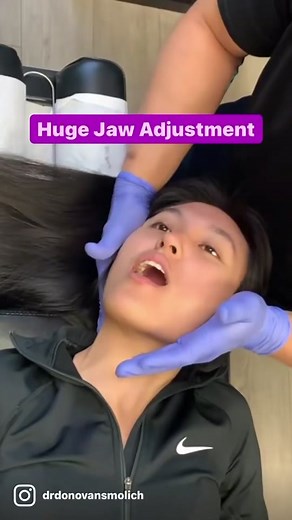 Are you experiencing TMJ pain and popping in your jaw? Check out this amazing jaw adjustment by Dr. Donovan Smolich! In this video, he brings back motion to a patient's jaw, along with adjusting her neck and releasing her internal pterygoid muscles in her mouth. This non-surgical alternative is a great option to consider before going under the knife. . TMJ pain can be caused by several factors such as teeth grinding while sleeping, chewing on tough food more on one side, dental work, and even ge