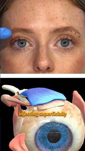 How to inject Botox under the brow for a lift
