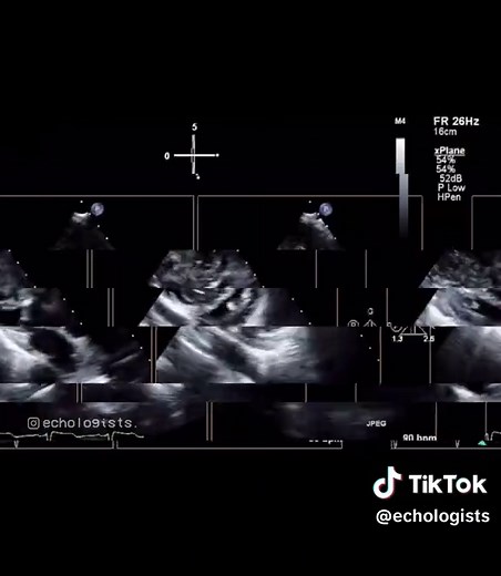 Understanding Angiosarcomas in Cardiac Health