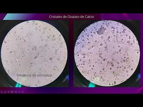 Sedimento Urinario en Microscopio | Con Asociación Clínica | 2a parte